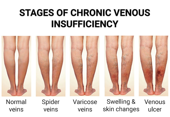 Venous Insufficiency - Vein & Endovascular Medical Care
