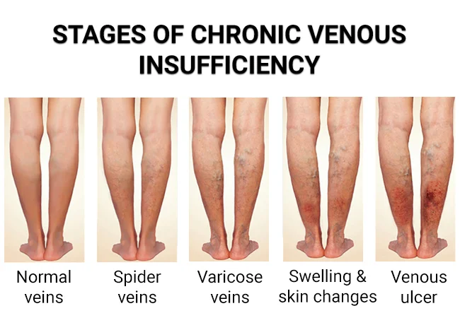 Diet and Varicose Veins - What's the Connection?