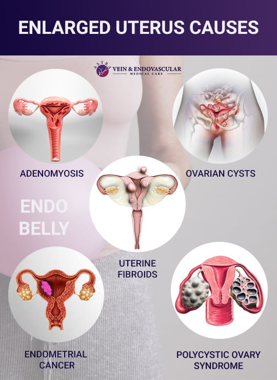 enlarged-uterus-vein-endovascular-medical-care