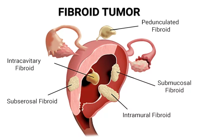 Fibroid Tumor Fibroid Cancer Vein Endovascular Medical Care