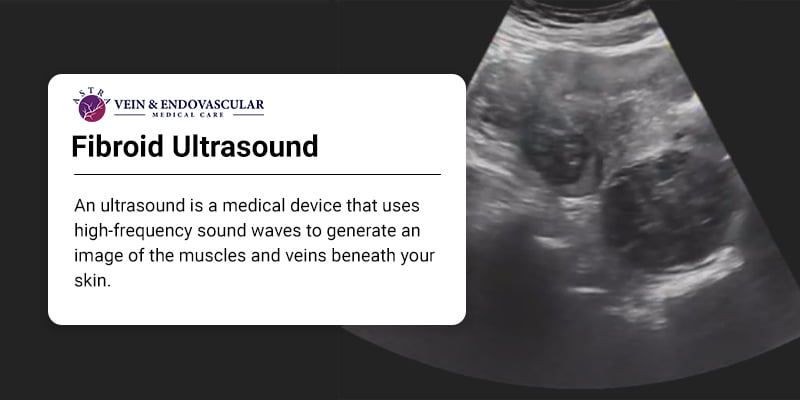 What Do Fibroids Look Like On Ultrasound