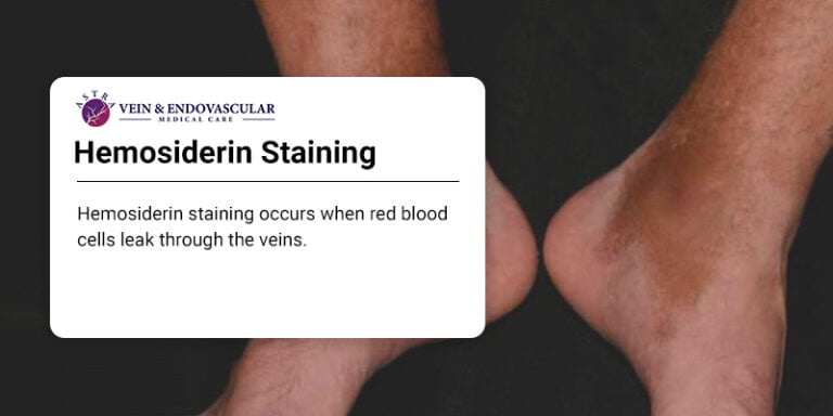 hemosiderin-staining-why-your-legs-are-turning-brown-vein