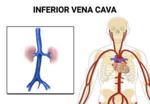 Inferior Vena Cava (IVC) Filter Placement and Removal Procedure - Vein ...