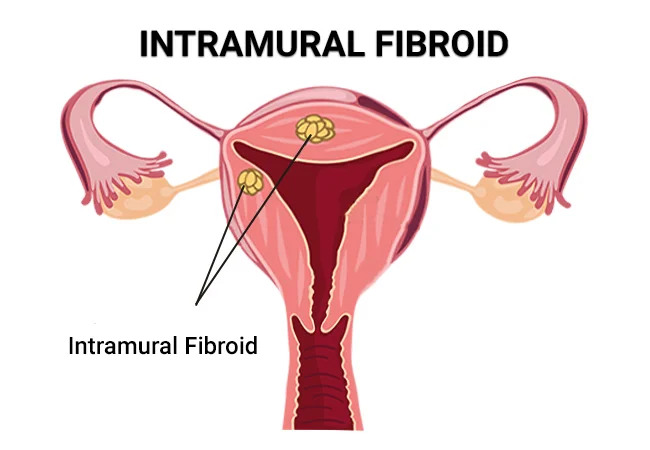 Are Blood Clots a Symptom of Fibroids?, New York City