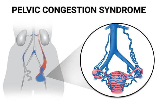 Pelvic Congestion Syndrome: Primary and Secondary Types