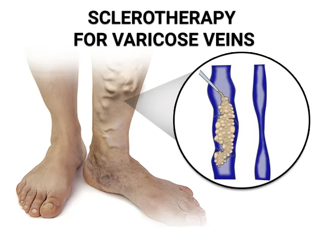 https://www.astraveinvascular.com/wp-content/uploads/2021/11/Sclerotherapy-for-Varicose-Veins.jpg.webp