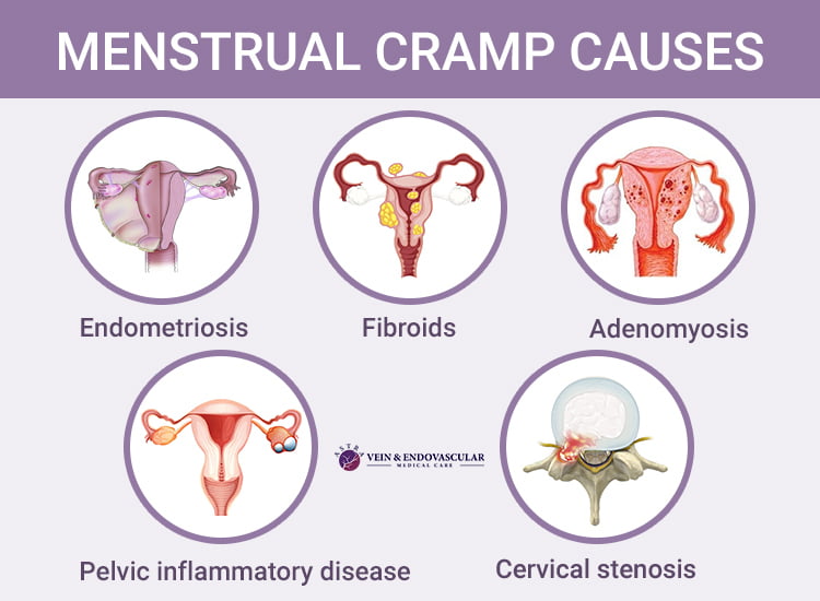 Severe Menstrual Cramp Relief