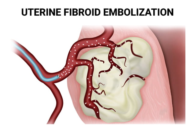Uterine Fibroid Embolization Ufe In Brooklyn Ny And Bronx Ny Vein