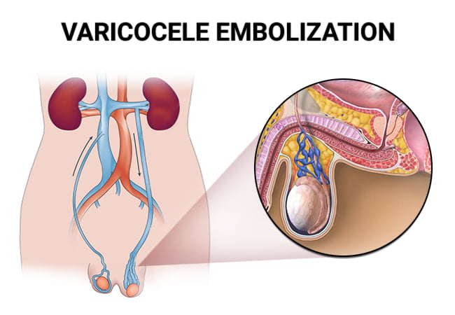 Micro varicocelectomy and Varicocele Embolization