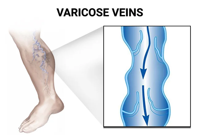 Varicose Vein Stripping Treatment vs. Sclerotherapy: Goldman Vein