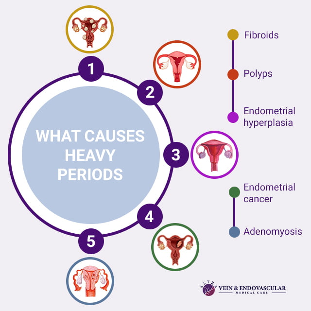 Heavy Periods Vein Endovascular Medical Care