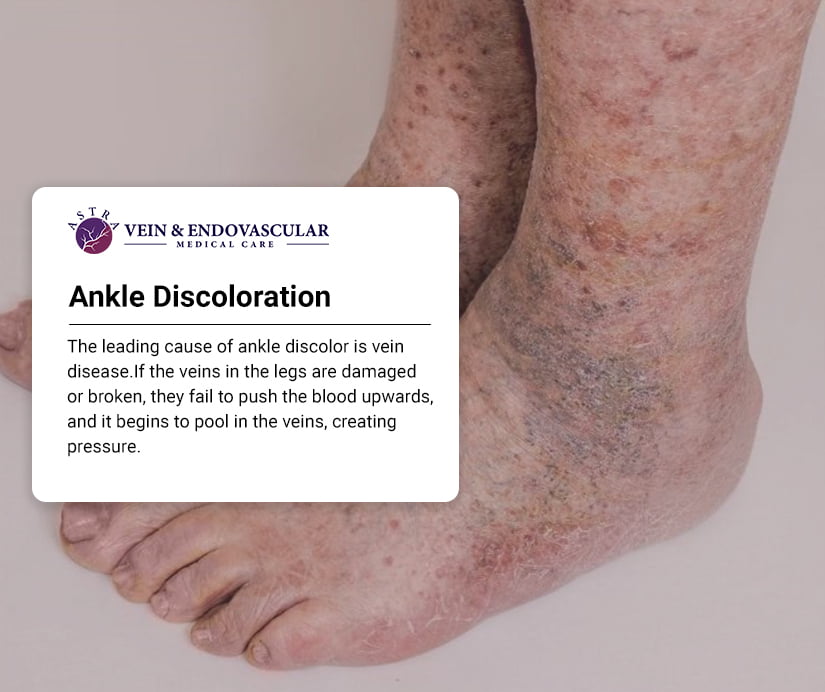 https://www.astraveinvascular.com/wp-content/uploads/2023/01/Ankle-Discoloration.jpg