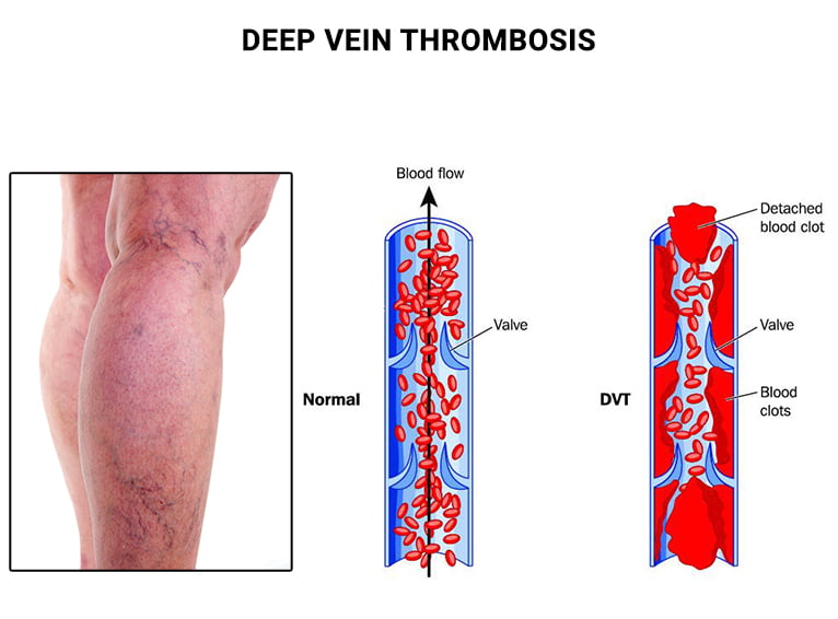 What Is Deep Vein Thrombosis (DVT)?