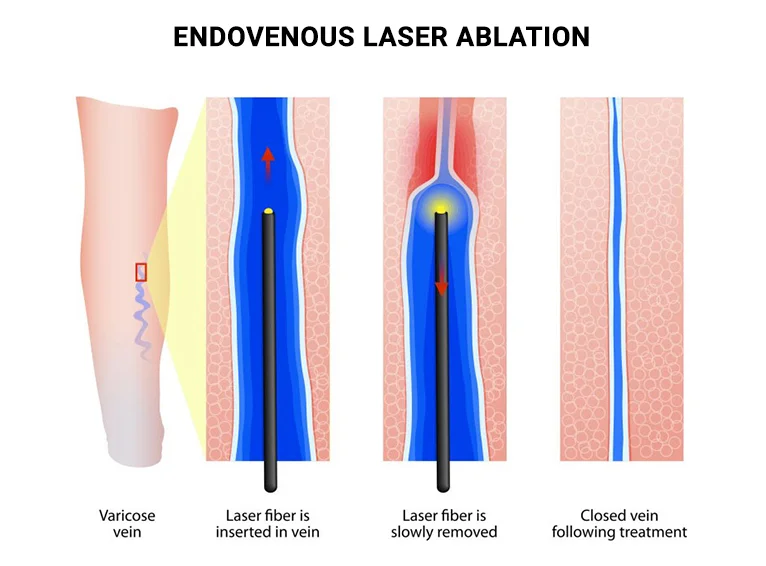Endovenous Laser Treatment (EVLT) Pensacola & Destin