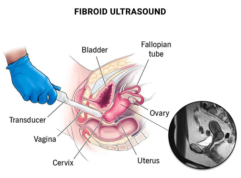 uterus fibroid ultrasound