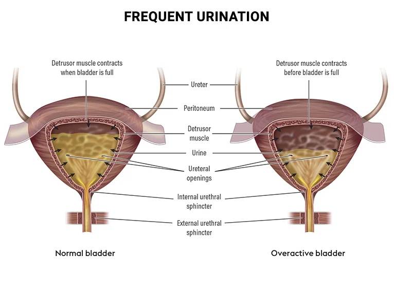 Symptom information - frequent urination