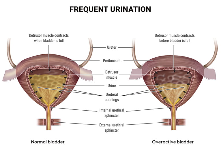 How To Stop Frequent Urination Vein Endovascular Medical Care