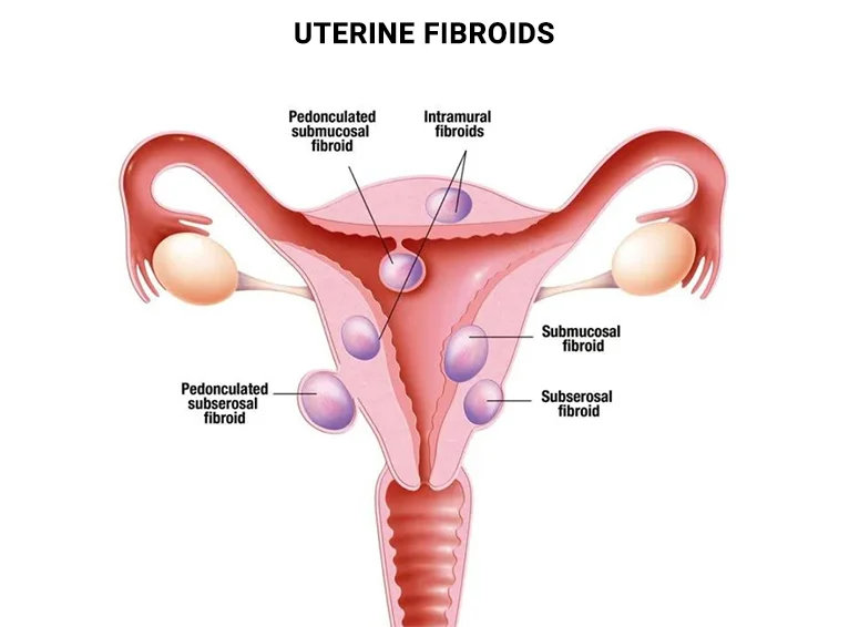 Hormone Treatment for Fibroids - Vein & Endovascular Medical Care