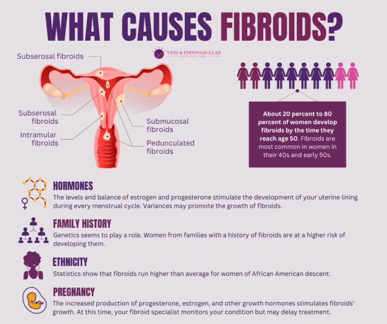 Fibroids Causes Vein And Endovascular Medical Care 1219