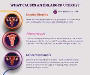 Enlarged Uterus - Vein & Endovascular Medical Care